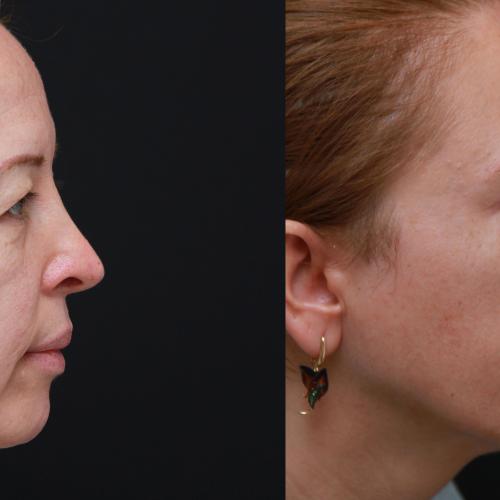Before after photos of our patients 0